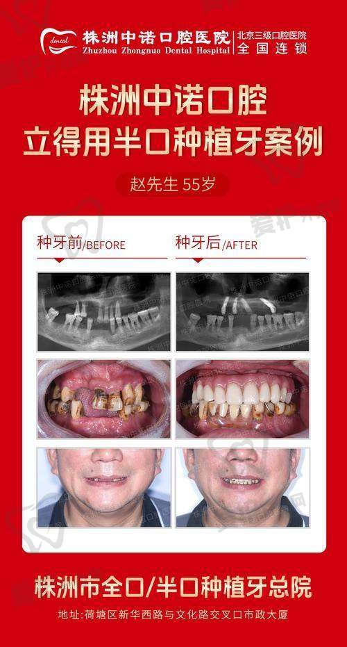 西安双宝口腔半口牙种植的成功实例有哪些？