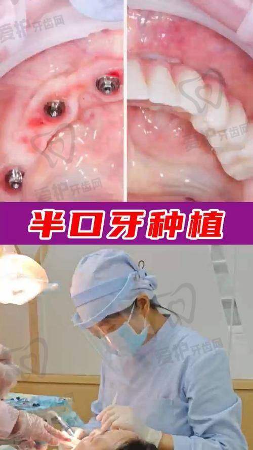 于洪海医生在半口牙种植领域有何优势？