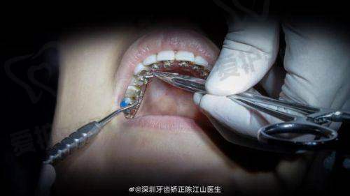 舌侧矫正是啥？
