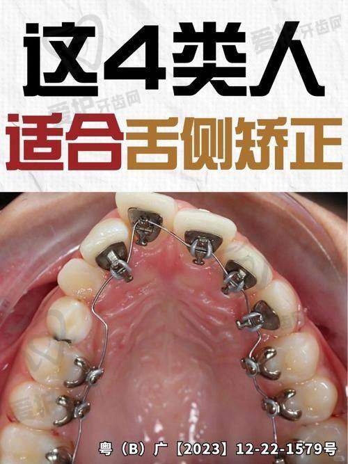 舌侧矫正适合所有人吗？