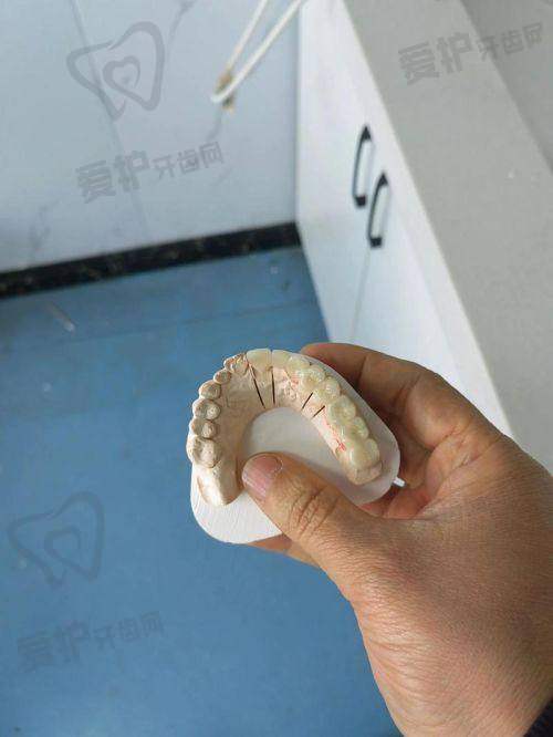 重庆团圆口腔医院爱尔创全瓷牙冠与其他品牌牙冠相比有何优势？
