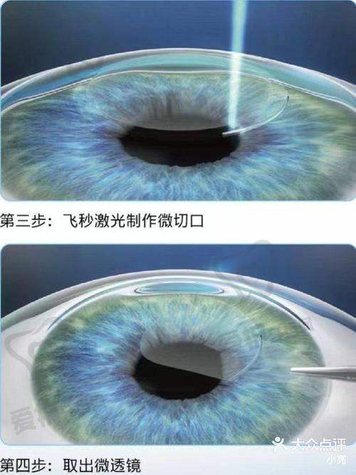 全飞秒手术是什么？为何如此受欢迎？