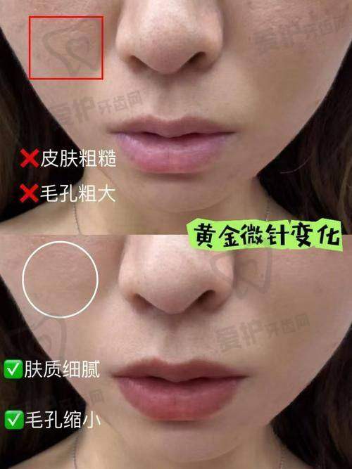 黄金微针和超声炮的成效维持时间一样吗？