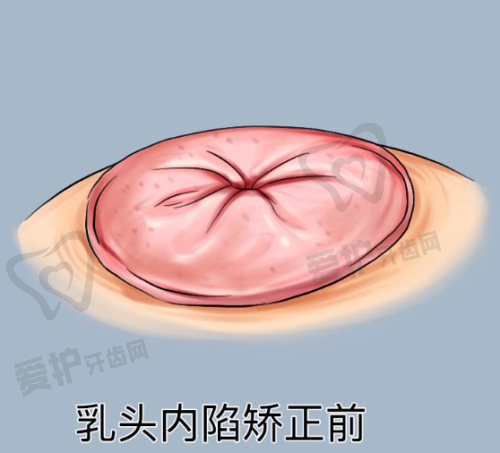 天使针天玑的独特优势