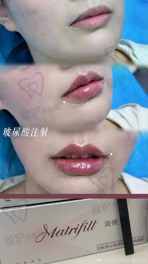 成都军大整形医院注射丰唇仅15800元起，开启水润丰盈美唇新体验！ 
