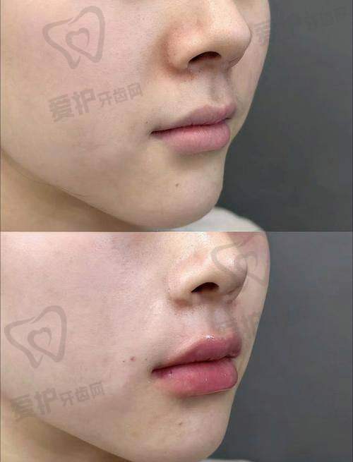 注射丰唇后需要注意什么?