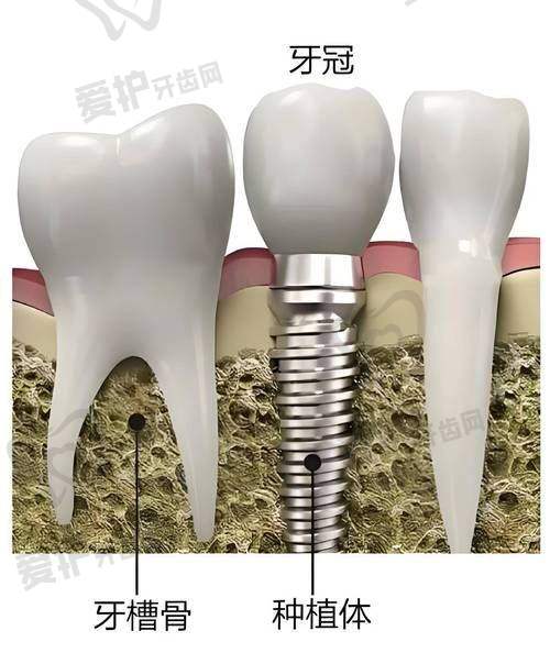 术前检查与方案设计:为种植牙奠定坚实基础