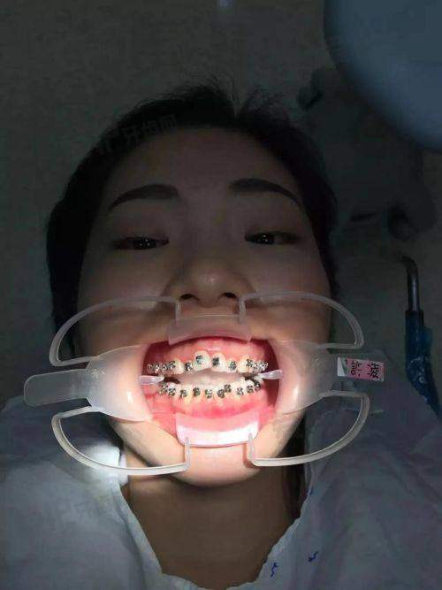 陶瓷托槽矫正和金属托槽矫正有什么不同?