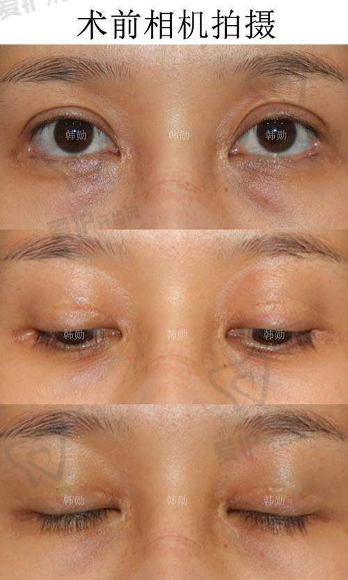 如何选择适合自己的双眼皮修复方案?