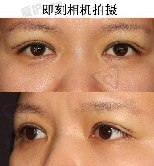 双眼皮修复的修复过程是怎样的?