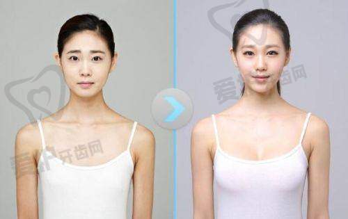 捷克水分子丰胸的成效