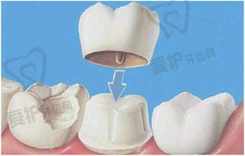 什么是爱尔创全瓷牙冠?