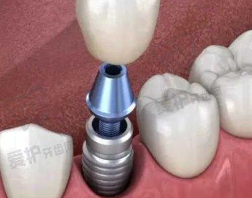 为什么选择天津蓟州京医口腔医院贾岩半口牙种植?