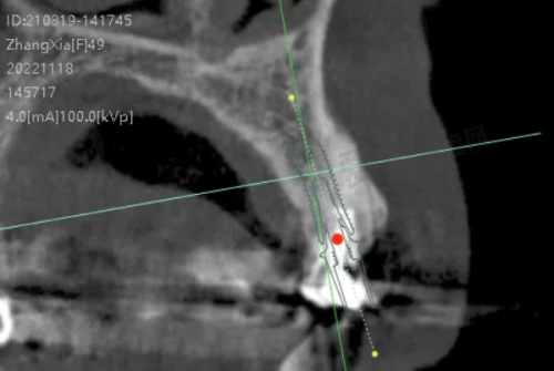 35000元起的半口牙种植包含什么?
