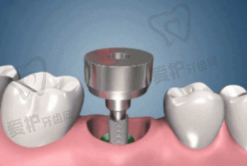 半口牙种植价格分阶情况如何?