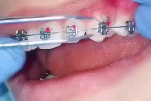 宁波牙博士口腔医院种植牙技术好不好？