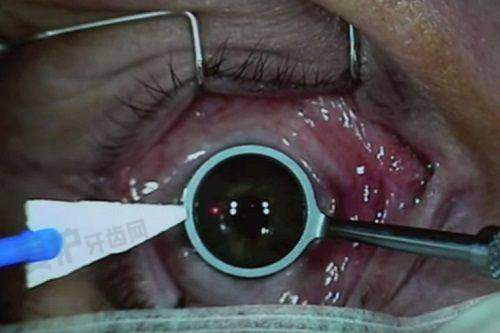 6800元起的斜视眼手术包含什么?