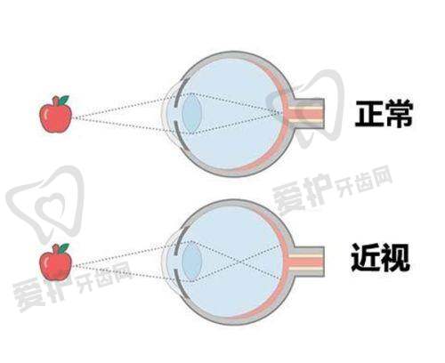 五、深圳佰视佳眼科医院收费价格: