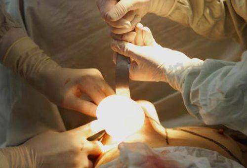 其他丰胸选择及推荐医院