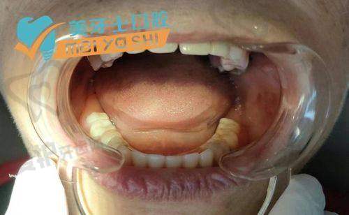 半口牙种植后需要注意什么?