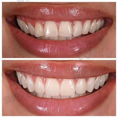 安装爱尔创全瓷牙冠后需要注意什么?