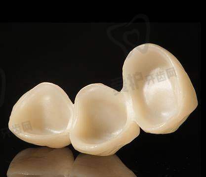 爱尔创全瓷牙冠的价格分阶情况如何?