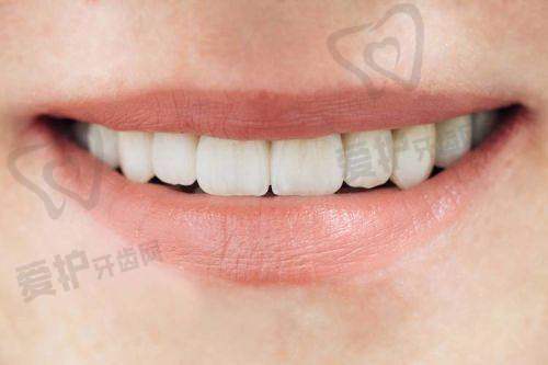 患者对三亚德川口腔爱尔创全瓷牙冠的评价如何?