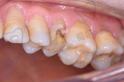 爱尔创全瓷牙冠未来的发展趋势如何?