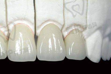 三亚德川口腔的爱尔创全瓷牙冠价格为何如此吸引人?