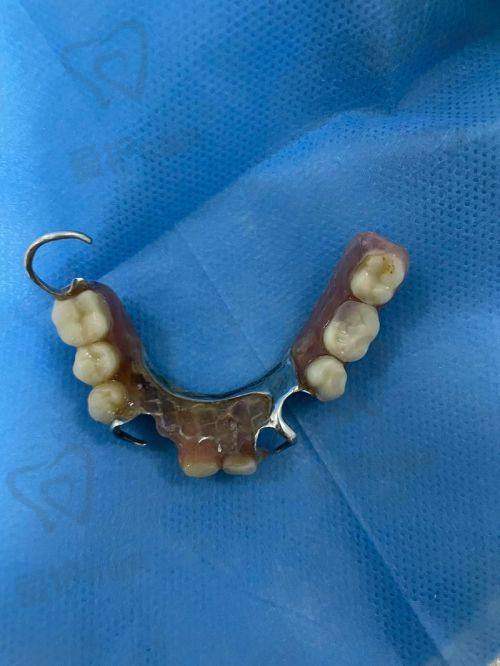 什么是全口活动假牙?