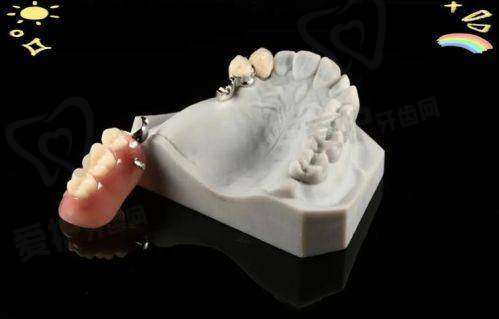 厦门麦芽口腔医院制作全口活动假牙的优势有哪些?