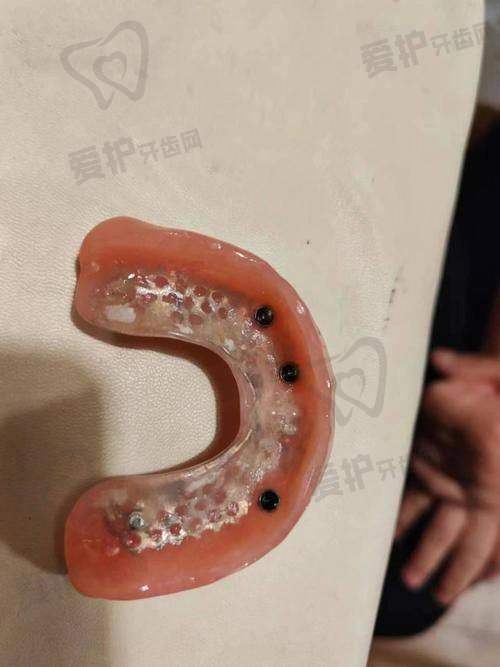 厦门麦芽口腔医院全口活动假牙价格为何10000元起?