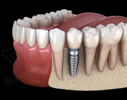 如何选择适合自己的全口活动假牙?