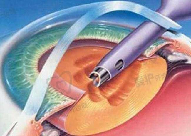 沈阳普瑞眼科医院全飞秒近视手术16600元起，高性价比助您告别模糊视界 