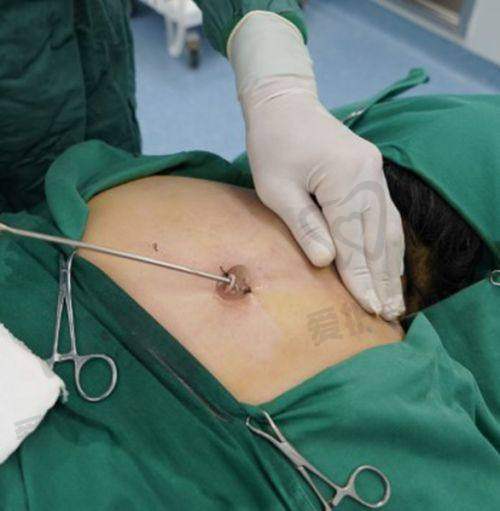 深圳今喜土麦森吸脂去富贵包的术后注意事项有哪些?