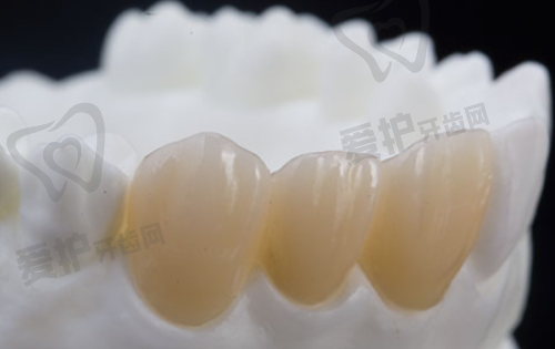 患者在广州雅皓口腔医院体验E.MAX全瓷冠治疗的流程是怎样的？