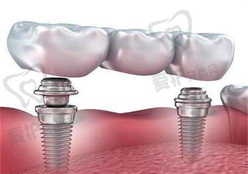 如何判断科威尔种植牙3000元是补贴还是陷阱?