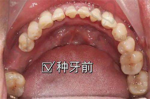 低价种植牙可能存在哪些陷阱?