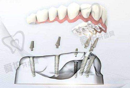 2、马鞍山鼎植口腔周路宽医生（擅长项目）怎么样？