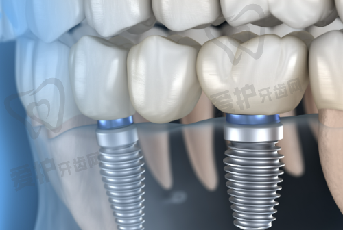 选择种植牙时还需要注意什么?