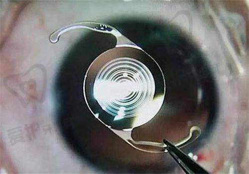 乌鲁木齐普瑞眼科医院半飞秒手术的术前术后注意事项有哪些?