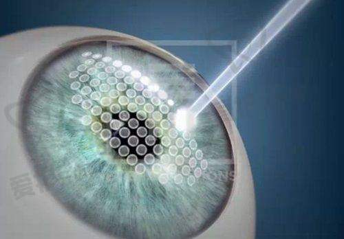 西宁爱尔眼科近视手术价目曝光：半飞1.1万起，这些隐藏费用要留意！