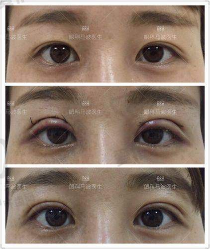 初眼整形13800元起的价格是如何构成的?