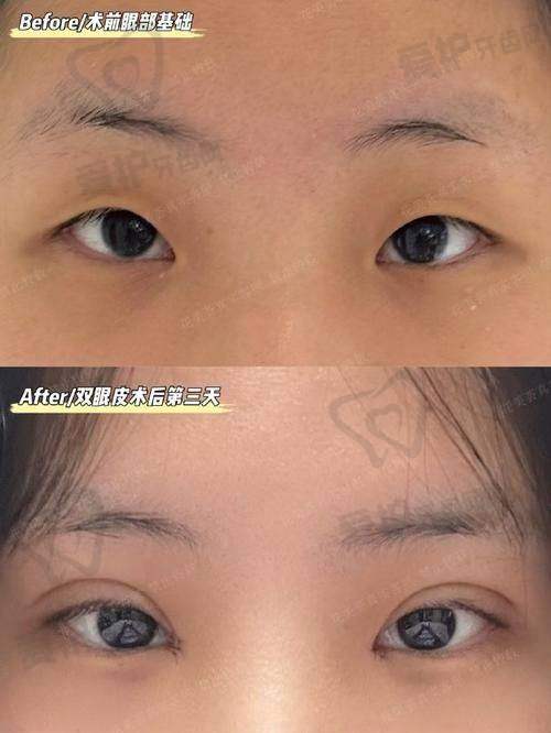 初眼整形能带来哪些改变?