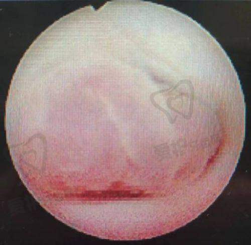 阴道紧缩术的术后护理需要注意什么?