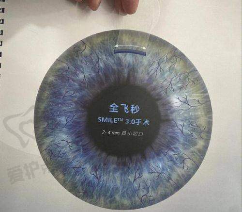 什么是眼睛飞秒手术?