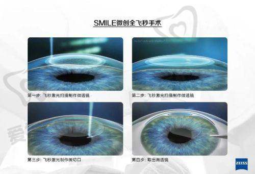 眼睛飞秒手术后遗症的发生率高吗?