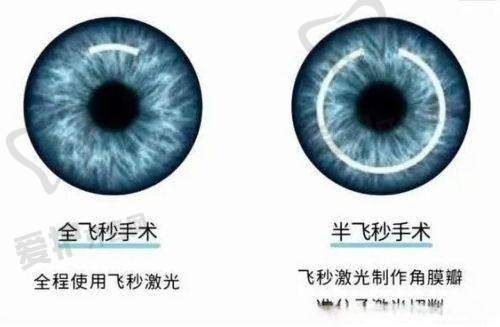 如何正确看待眼睛飞秒手术的后遗症?