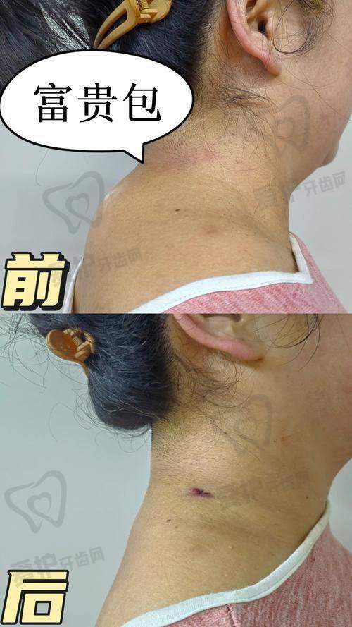 深圳今喜土麦森吸脂去富贵包的成效如何?