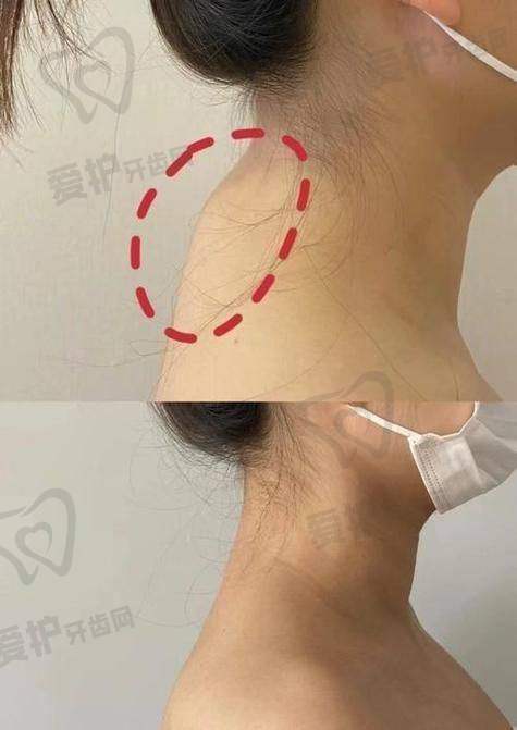 深圳今喜土麦森吸脂去富贵包的价格是如何确定的?